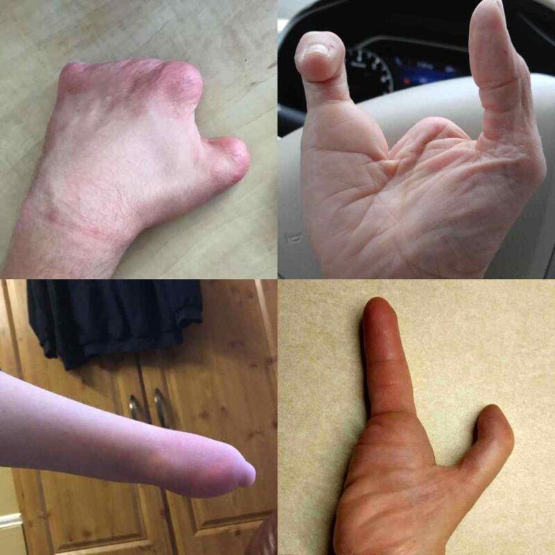 Active Hands limb difference aid
